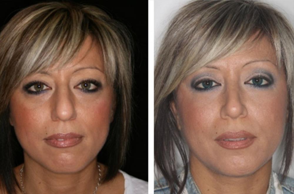 Rinoplastica prima/dopo - Immagine 11