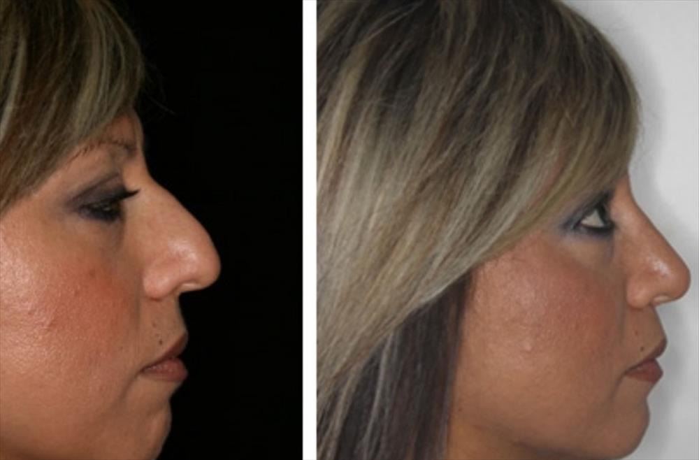 Rinoplastica prima/dopo - Immagine 12