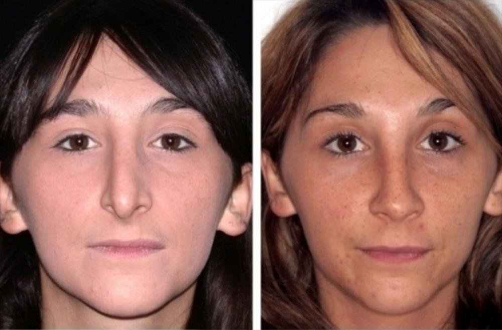 Rinoplastica prima/dopo - Immagine 15