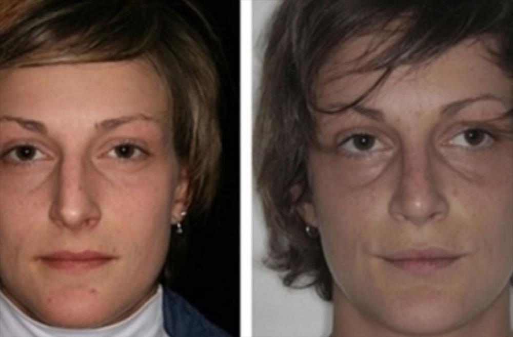 Rinoplastica prima/dopo - Immagine 17