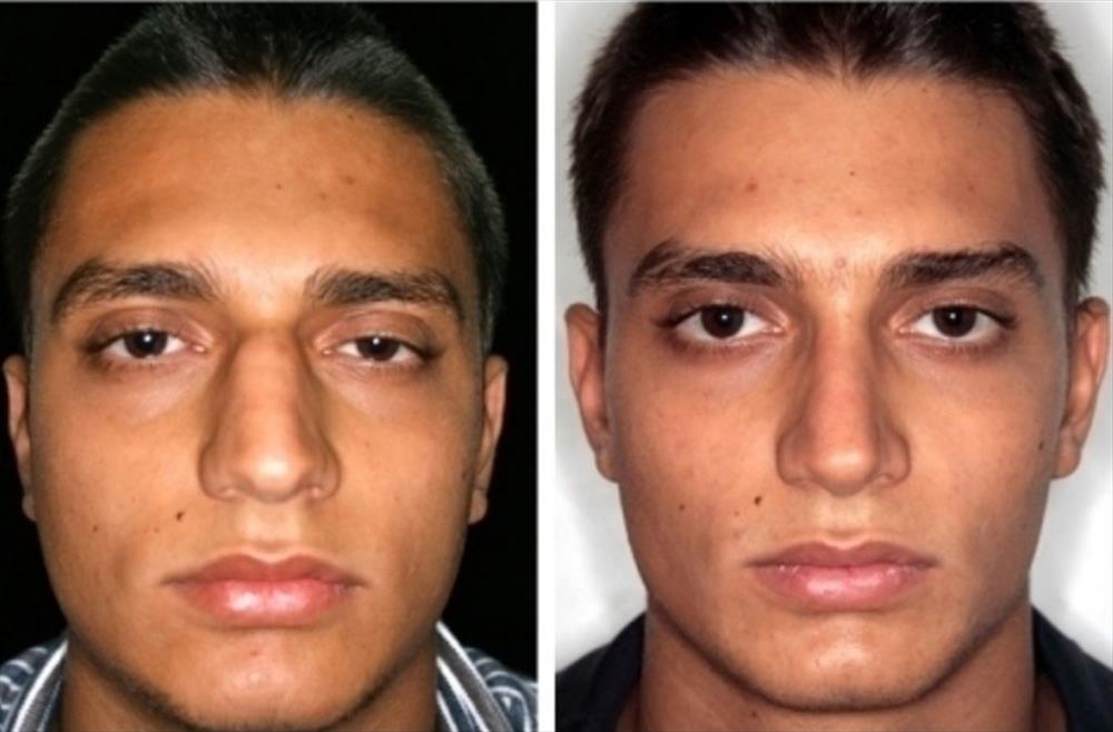 Rinoplastica prima/dopo - Immagine 9