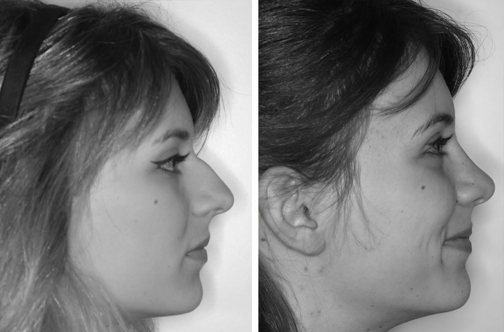 Operazione naso prima/dopo profilo