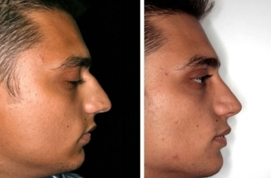 Operazione naso prima/dopo profilo