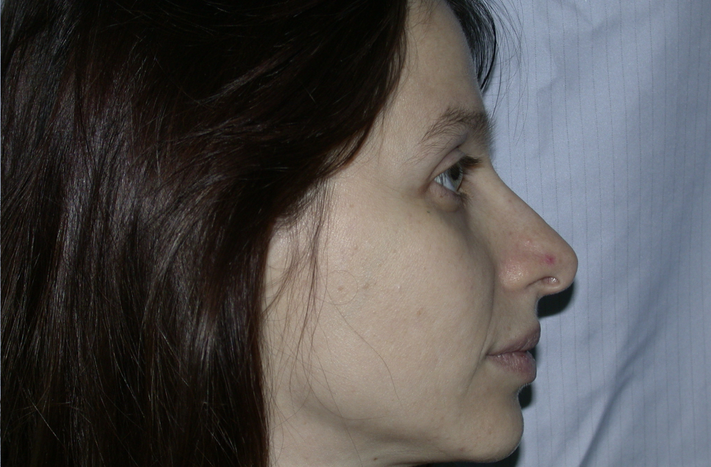 Rinoplastica prima/dopo vista frontale