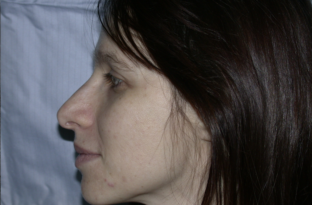 Rinoplastica prima/dopo vista frontale